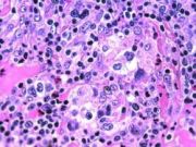 Hodgkin's Lymphoma